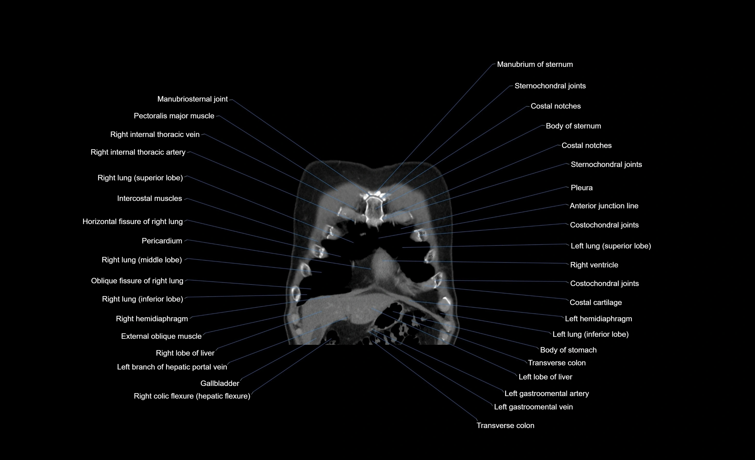 CT chest (thorax) soft tissue window labelled coronal cross sectional anatomy radiology image-00097.webp